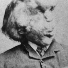 Joseph Merrick