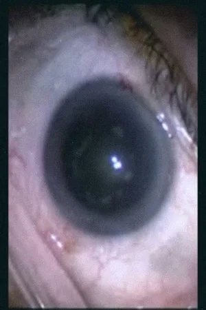 Постер: Botched Eyeball Operation